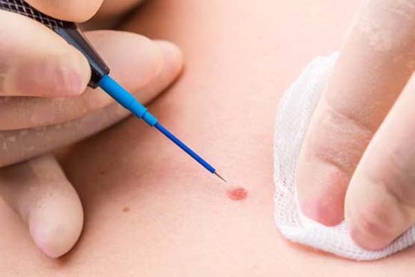 Trusted experts providing genital warts laser Mashhad